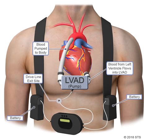 ventricular assisted devices